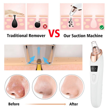 MB Mart® Vacuum Blackhead Remover – Deep Pore Cleaner for Clear Skin